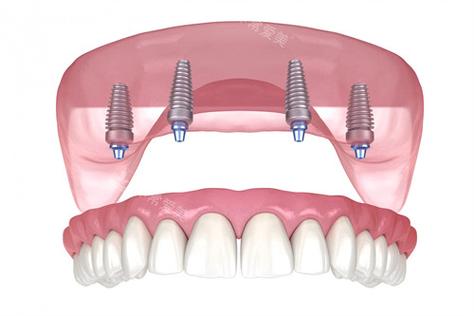 种牙 德国系统-图3