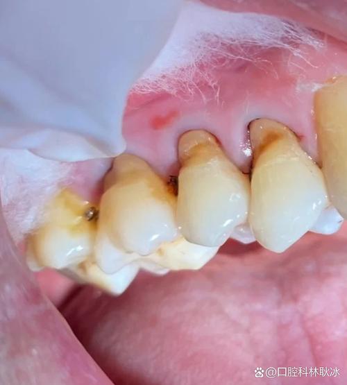 种牙 金属过敏-图2