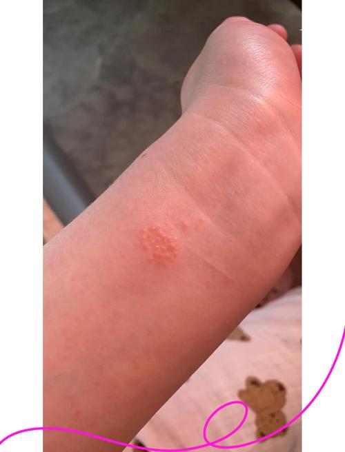 种牙 金属过敏-图3