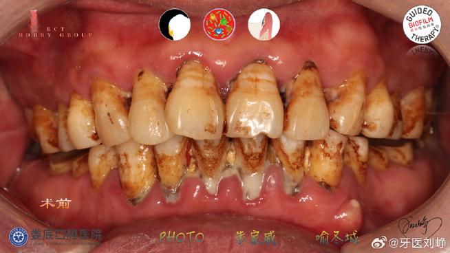 种牙 金属过敏-图1 种牙 金属过敏-图1
