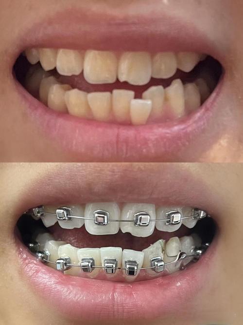 门牙牙缝2mm正畸能关闭吗？如何矫正？效果如何？-图2