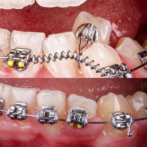 牙齿正畸添加的零件-图3
