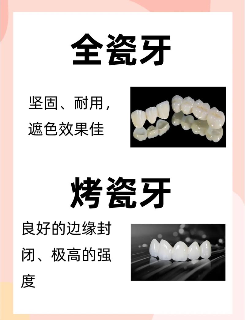 装牙还是种牙好-图2