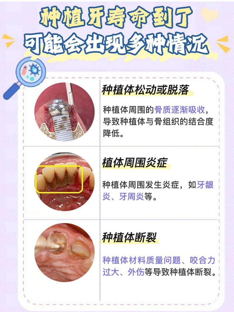 套牙种牙的寿命-图1