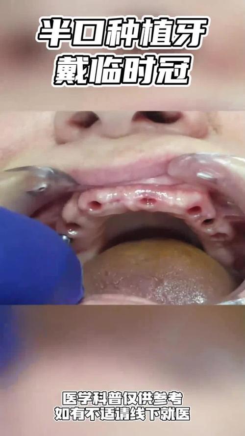 种牙半年后才戴牙？中间要经历哪些关键步骤？-图3