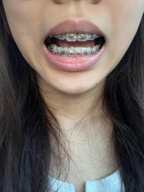 种牙半年后才戴牙？中间要经历哪些关键步骤？-图2