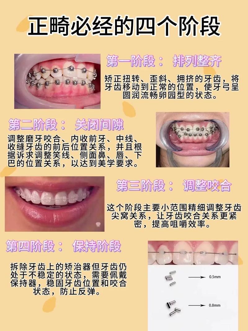 正畸如何将上牙前推-图1