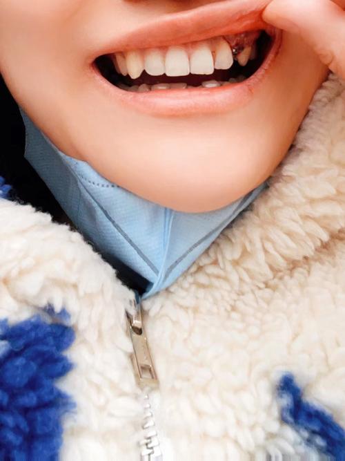 admin种牙效果究竟如何？真实体验值得大家参考吗？-图2