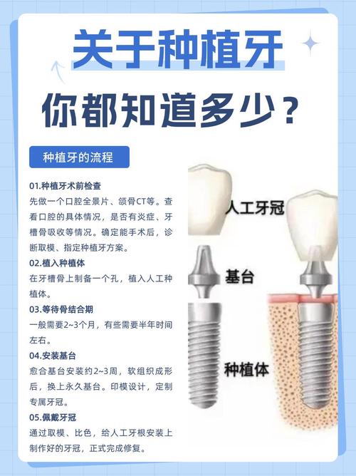 种植牙种牙时间多久？不同情况具体耗时差异大吗？-图3
