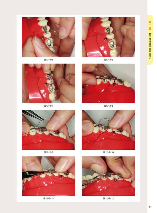 正畸弓丝自行车教程-图2