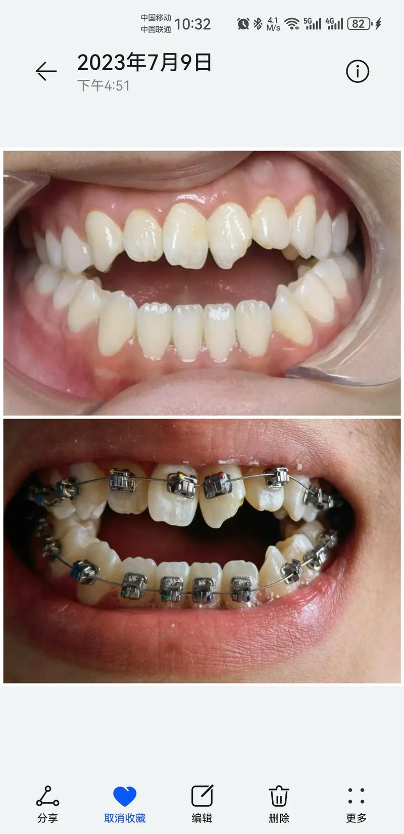 正畸怎么矫成开颌了-图2