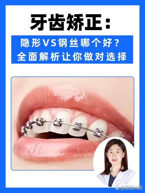 正畸的牙套区别大吗-图3