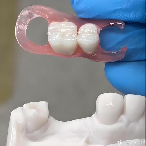 种牙镶牙活动牙-图3