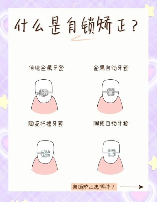 自锁正畸需要分牙吗-图1