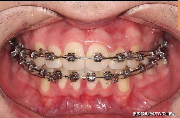 自锁正畸需要分牙吗-图3