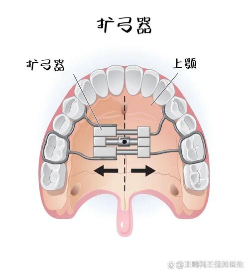 正畸弹力线示意图，如何看懂牙齿移动的隐形轨迹？-图1