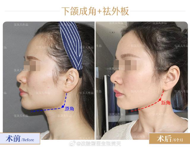 骨性正畸能变脸型吗-图1