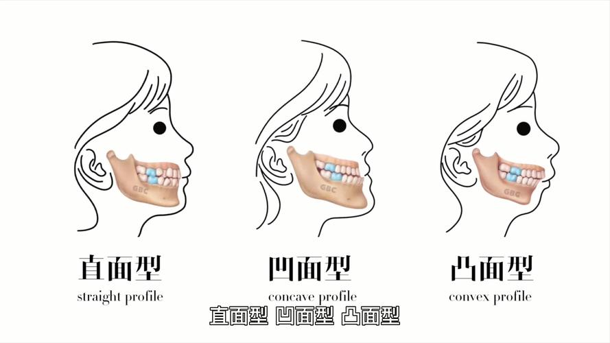 骨性正畸能变脸型吗-图3