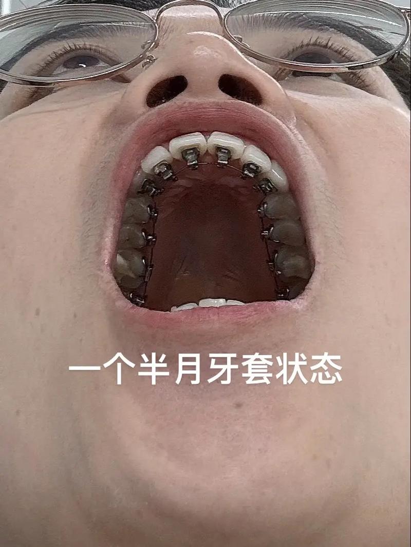 舌侧正畸费用大概需要多少钱？-图2