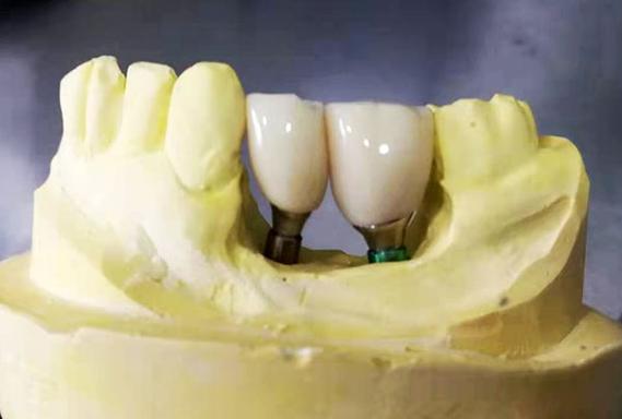 洛阳种牙哪家好-图3