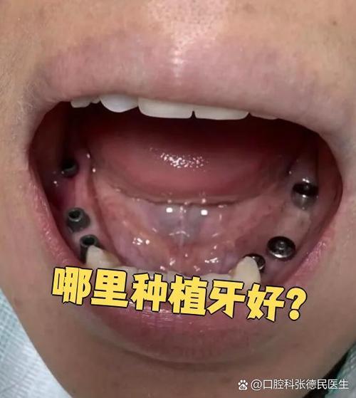 珠海种牙哪里好?求推荐技术好、口碑佳的靠谱医院-图3 珠海种牙哪里好?求推荐技术好、口碑佳的靠谱医院-图3