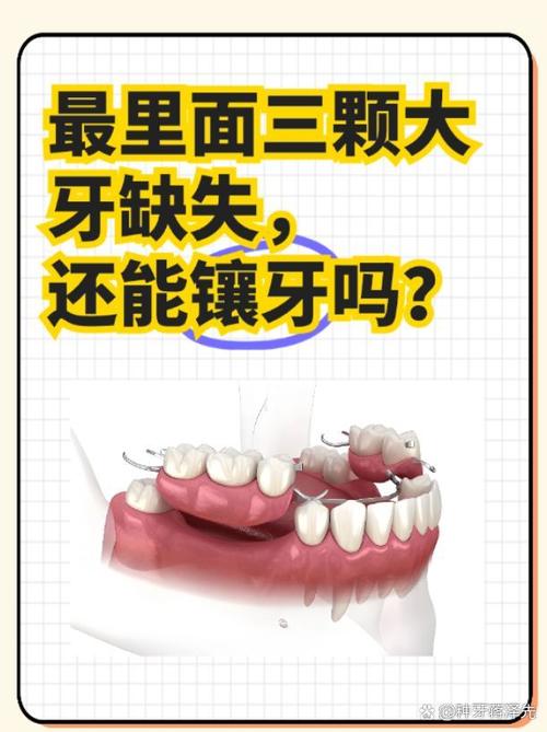 最多能种几颗牙-图1