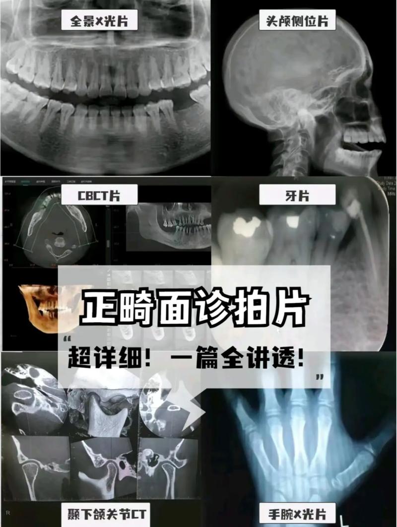 正畸拍什么片多少钱-图1 正畸拍什么片多少钱-图1