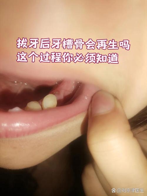 拔牙后不能种牙-图2 拔牙后不能种牙-图2