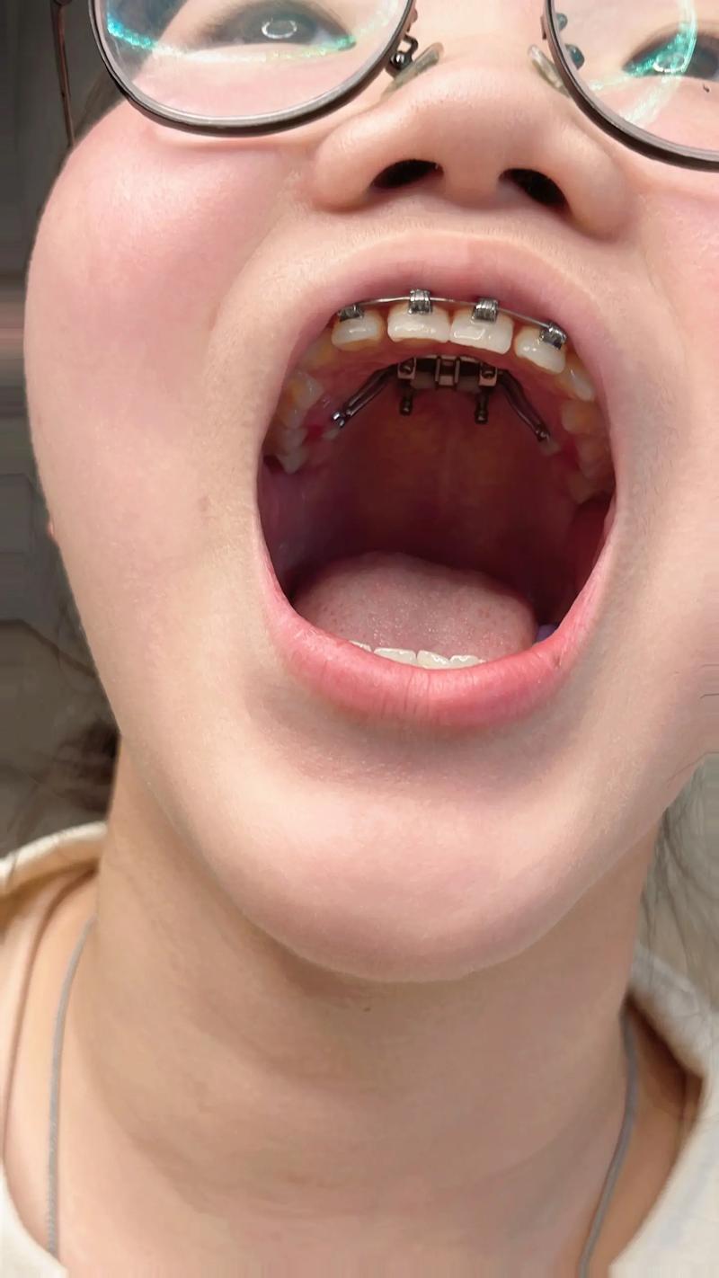 正畸隐形矫治器开孔有何作用?对矫治效果有何影响?-图1 正畸隐形矫治器开孔有何作用?对矫治效果有何影响?-图1