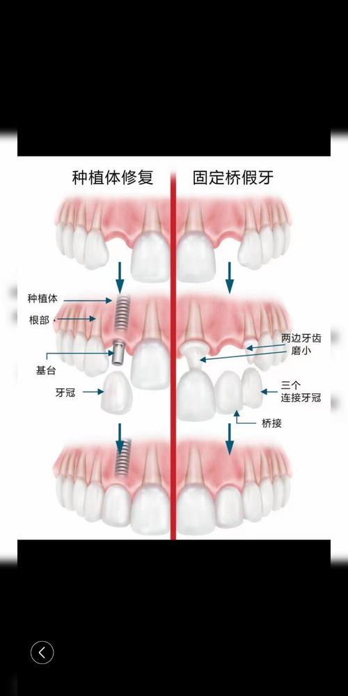 做牙冠还是种牙-图3