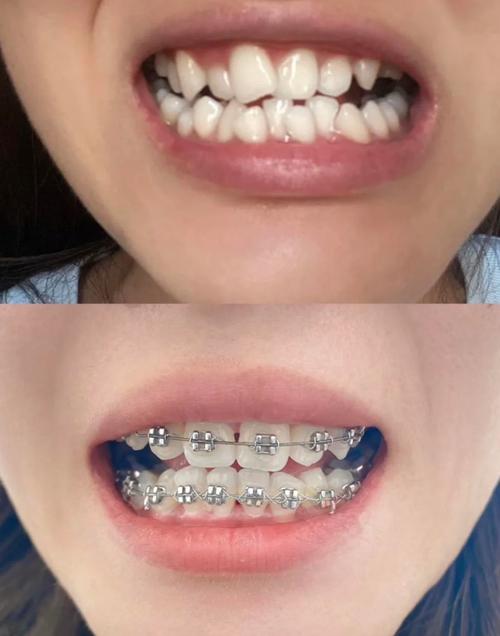 正畸矫正后牙齿易掉-图1