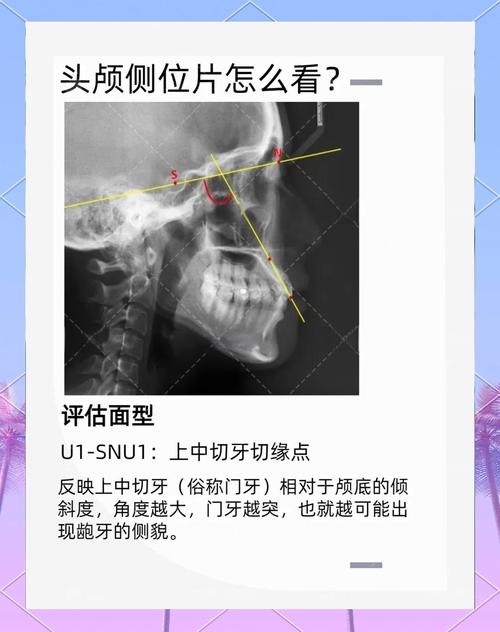 正畸头侧位影像中Z点该如何精准定位？-图1