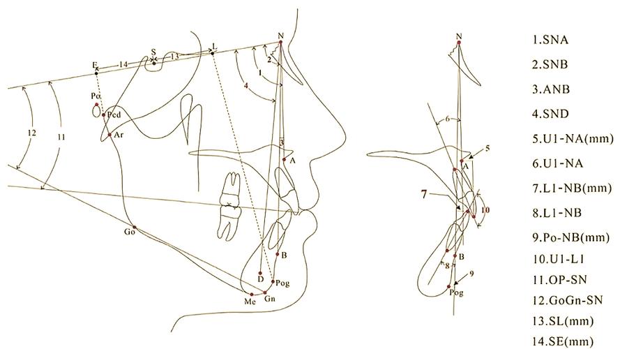 正畸头侧位影像中Z点该如何精准定位？-图3