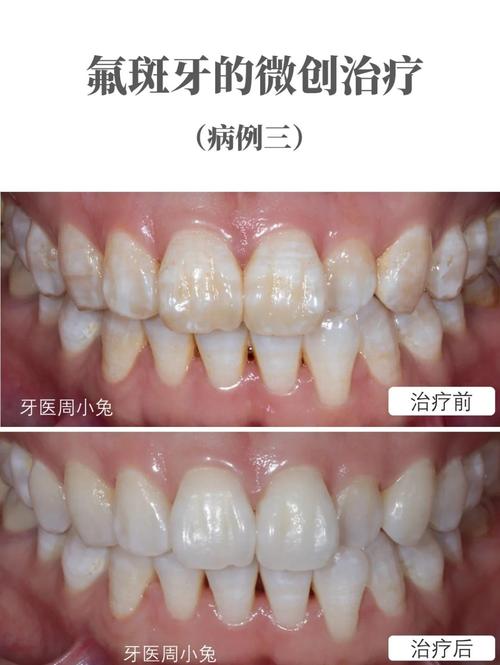 氟斑牙可以做正畸矫正吗?-图2 氟斑牙可以做正畸矫正吗?-图2