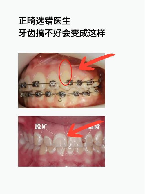 正畸后牙齿脱矿是什么原因？该如何科学预防与处理？-图1