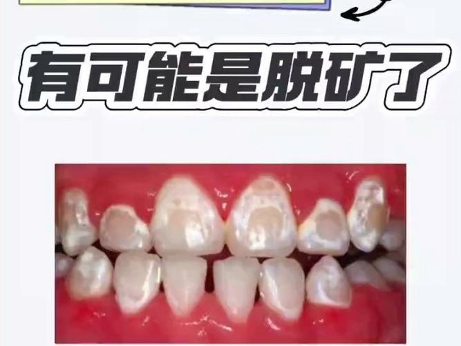 正畸后牙齿脱矿是什么原因？该如何科学预防与处理？-图3