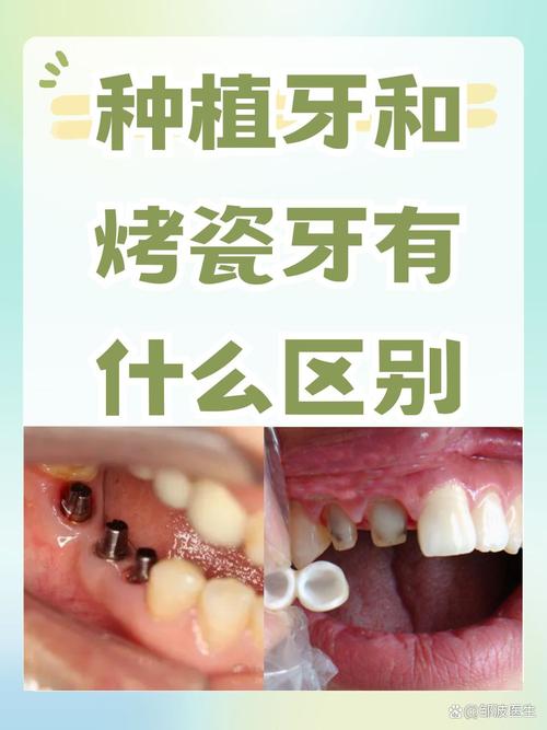 种牙和补牙区别-图2