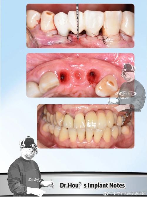 种牙失败的表现-图1