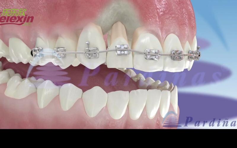 正畸三角垂直牵引法-图3