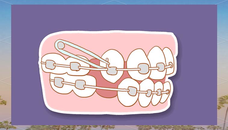 正畸三角垂直牵引法-图2