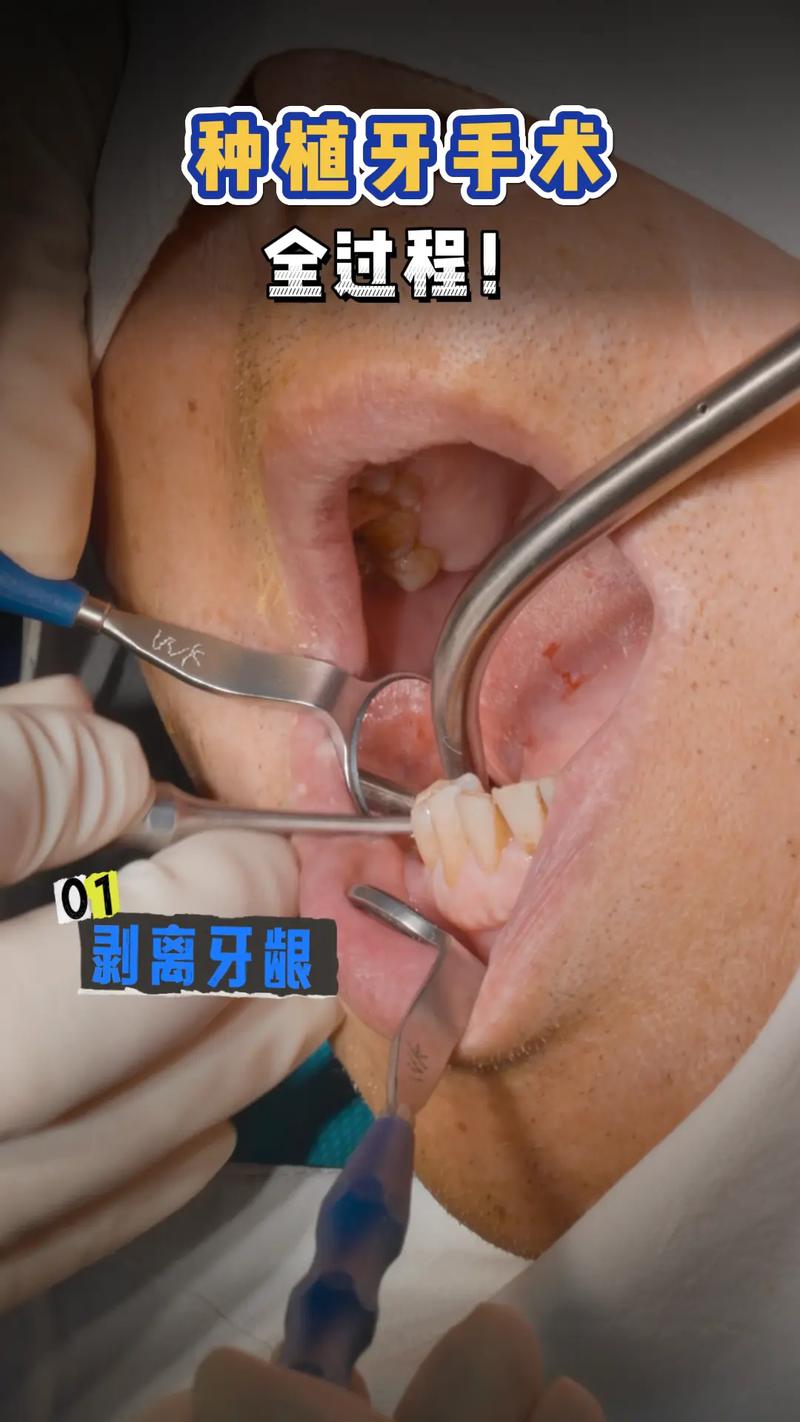 微创种牙怎么样-图3