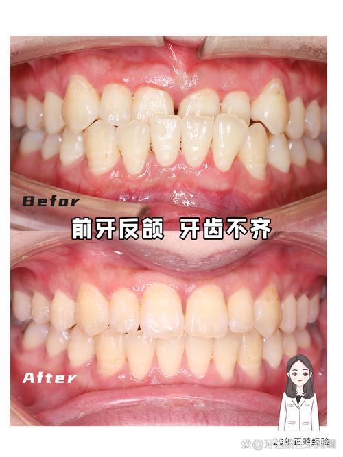 不拔牙的正畸效果图-图2