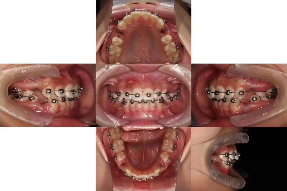 正畸时粘托槽的正确步骤是怎样的？-图3