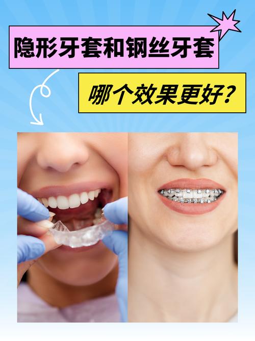 正畸牙套怎么选？隐形/金属/陶瓷哪种更适合？-图3