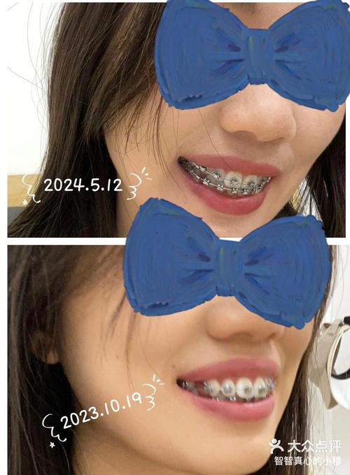 牙齿正畸 拔四颗牙-图1