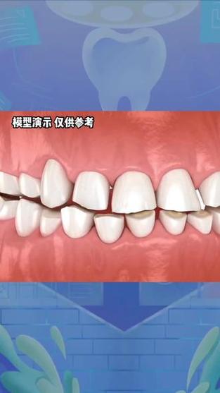 夜磨牙能种牙吗-图2