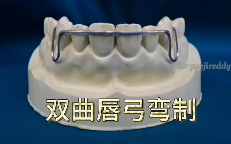 正畸双曲唇弓如何做-图1