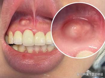 种牙后牙龈脓包-图3 种牙后牙龈脓包-图3