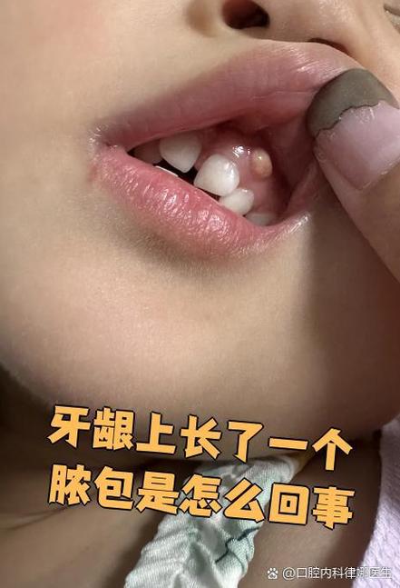 种牙后牙龈脓包-图1 种牙后牙龈脓包-图1