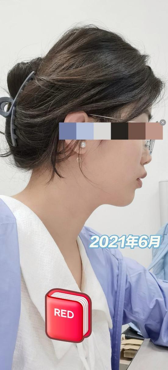 正畸后改变下颌后缩-图2